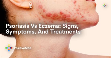 Psoriasis Vs Eczema Signs Symptoms And Treatments Positivemed