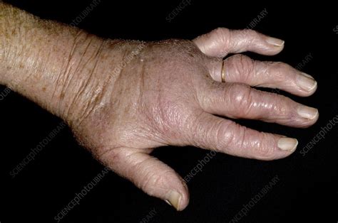 Swollen Hand From Insect Bite Stock Image C0169220 Science Photo
