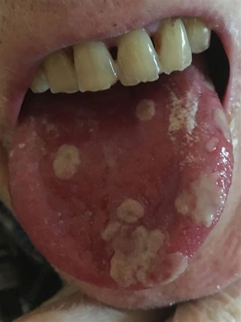 Oral Lesions In An Immunocompromised Patient The Bmj