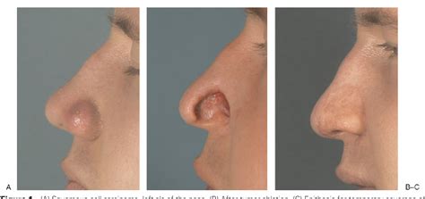 One Stage Reconstruction Of Nasal Defects Evaluation Of The Use Of