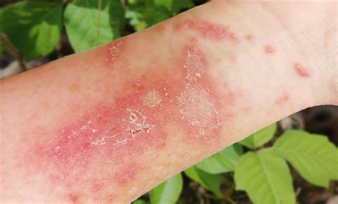 Poison Ivy 101 Mercy Providers Urge Precaution Offer Tips Mercy