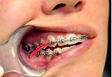 Images of Where To Get Orthodontic Rubber Bands