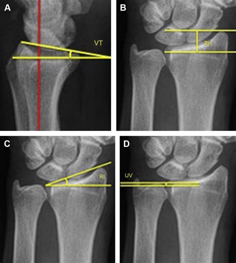 Optimal Positioning For Volar Plate Fixation Of A Distal Radius Fracture Orthopedic Clinics
