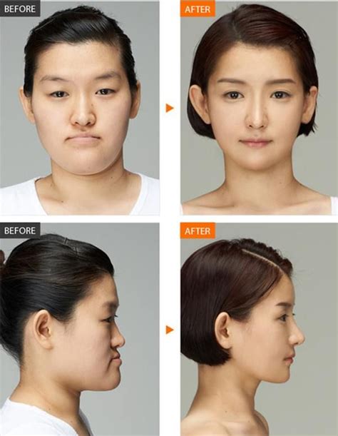 Pin En Plastic Surgery