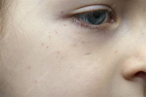 Purpura Rash Around The Eye Stock Image C0166933 Science Photo