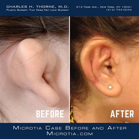 Ear Reconstruction Microtia Case Before And After Surgery