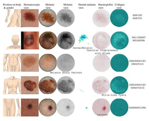 Accuracy Of Siascopy For Pigmented Skin Lesions Encountered In Primary