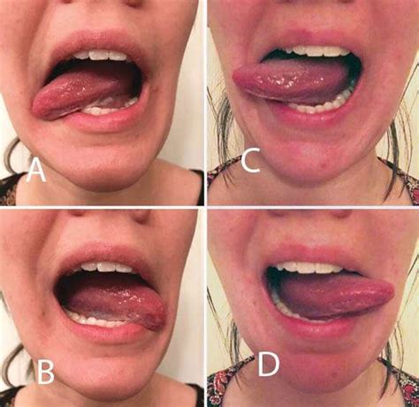 The Importance Of Orofacial Myofunctional Therapy Before And After Co2 Laser Frenectomy In
