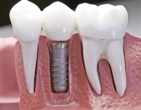 Dental Implants West Palm Beach Fl Restore Your Smile