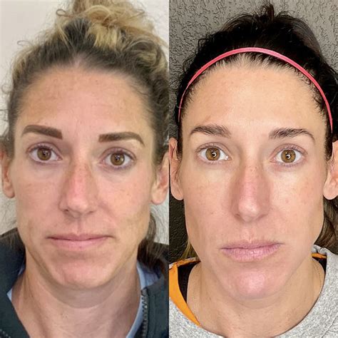 Before And After Prp Injections Procedures Dr William Harris