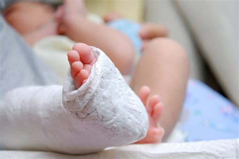 Clubfoot Treatment For Babies Doctorvisit