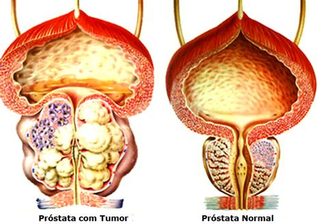 Explains prostate problems including prostatitis and benign prostatic hyperplasia. 68.220 casos novos de câncer de próstata devem surgir até ...