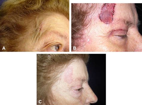 Case 2 A Frontotemporal Region Basal Cell Carcinoma B 7 Days
