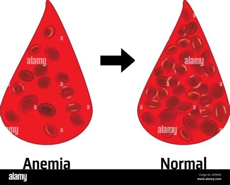 Normal Blood Cell Anemia Stock Vector Images Alamy
