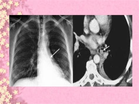 Lung Carcinoid Tumor