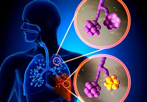 Pneumonie Par Aspiration Symptômes Traitement Causes Maladies 2022