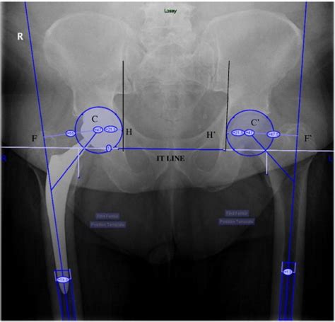 Reproduction Of Hip Offset And Leg Length In Navigated Total Hip Arthroplasty How Accurate Are