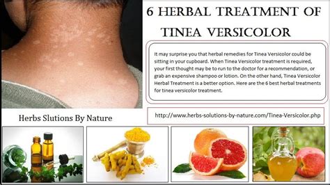 6 Herbal Treatment Of Tinea Versicolor By Herbssolutionsbynature Medium