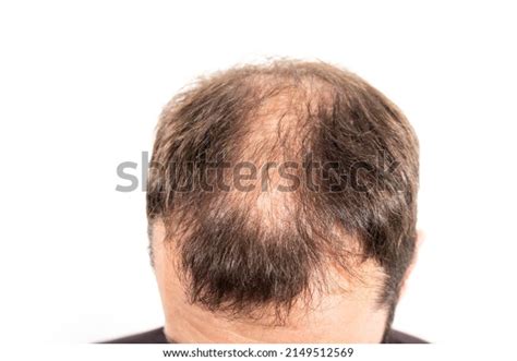 Closeup Balding Head Young Man On Stock Photo 2149512569 Shutterstock