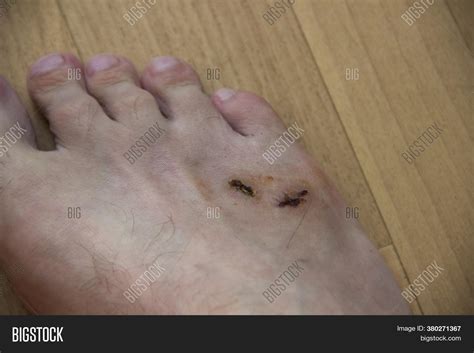 Sick Leg Wounds On Image And Photo Free Trial Bigstock