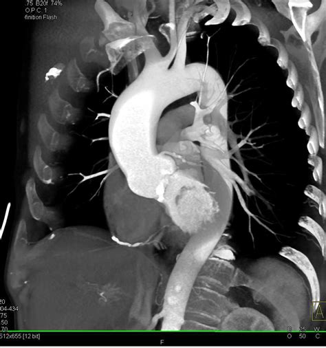 Aortic Stenosis With Calcified Bicuspid Aortic Valve Vascular Case