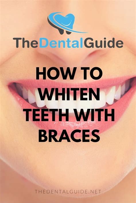 How To Whiten Teeth With Braces The Dental Guide