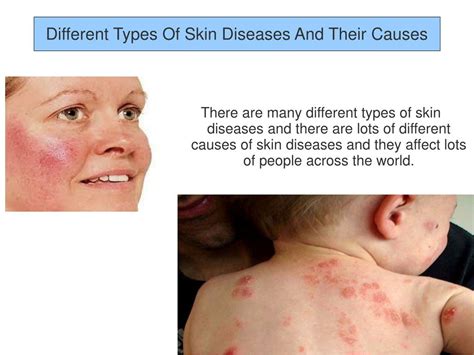 Ppt Different Types Of Skin Diseases And Their Causes Powerpoint