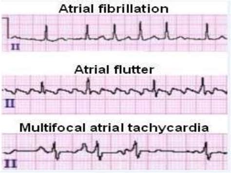 aflutter vs afib atrial flutter litfl ecg library diagnosis the two terms are similar types