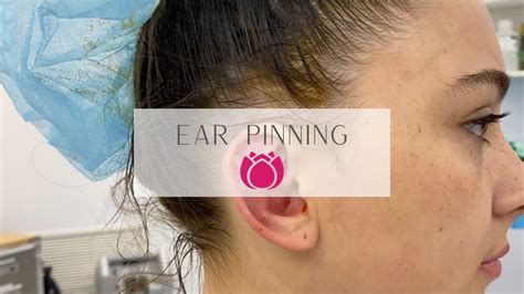 Ear Pinning Cosmetic Surgery Affiliates Youtube