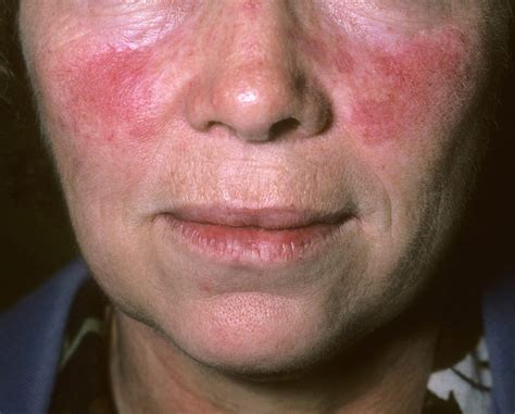 Botulinum Toxin Type A Effective For Treating Rosacea Facial Flushing