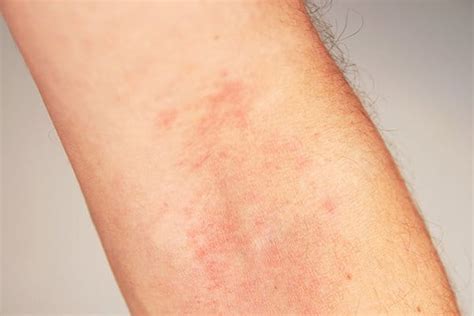 Atopijski dermatitis Atopična koža Eucerin