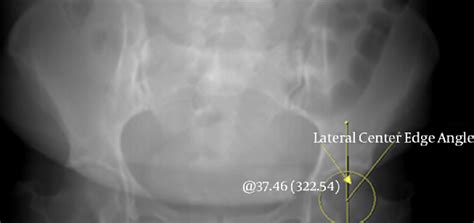 Acetabular Index Line A Joins The Lateral Edge Of The Acetabulum And