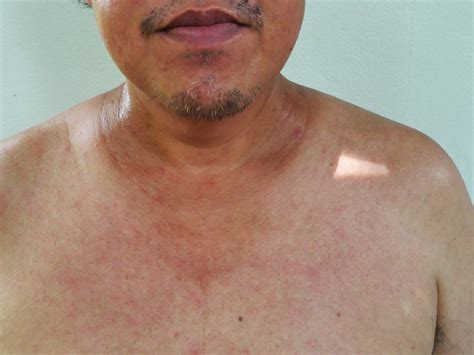 Small Cell Lung Cancer With Hyperpigmentation