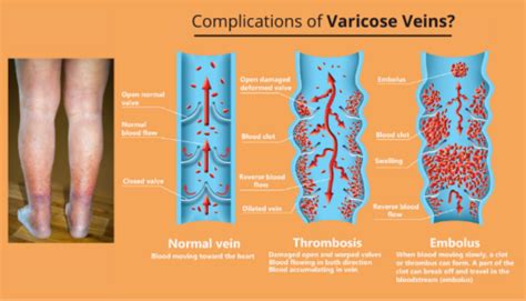 What Are The Complications If Varicose Veins Are Not Treated Dr Abhilash