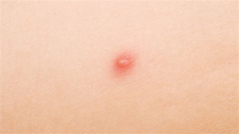 Four Symptoms Of Hives You Should Know Page 2 Entirely Health