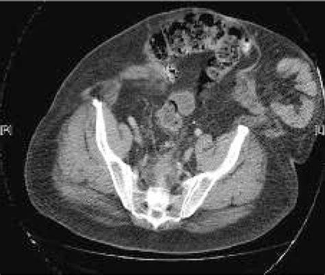 Giant Incisional Hernia With Loss Of Domain Download Scientific Diagram