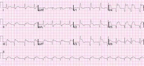 Dr Smiths Ecg Blog Large Transmural Stemi With Myocardial Rupture