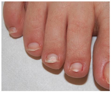 Does Nail Fungus Go Away On Its Own