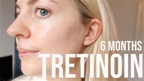 Topical tretinoin is the most extensively investigated retinoid therapy for photoaging. Acretin For Acne Treatment - Office Manager Cover Letter