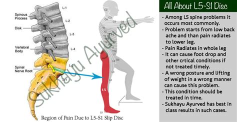 Exercises For L4 L5 Back Pain Online Degrees
