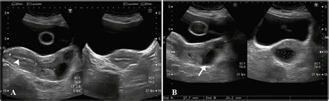 [34 ] Uterine Prolapse Ultrasound Radiopaedia