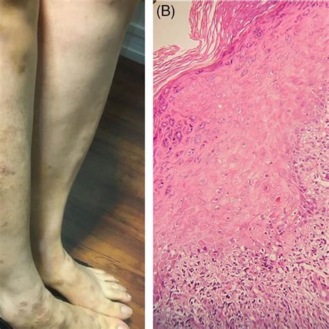 A Multiple Erythematous Papules And Plaques On The Extremities