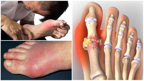 Сбросить вес народными средствами Подагра - лечение в домашних условиях народными средствами. - Женский Подагра - лечение в домашних условиях народными средствами. - Женский Сбросить вес народными средствами