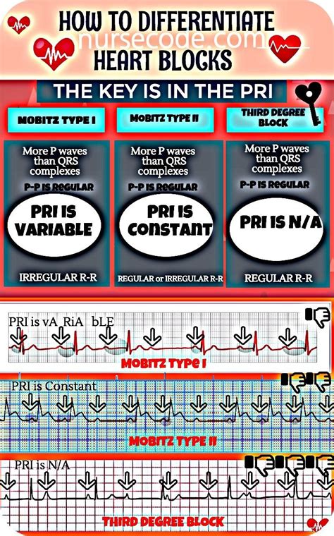 How To Differentiate Heart Blocks Inforgraphic Icu