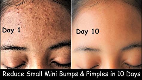 Get Rid Of Tiny Bumps On Face Small Head Bumps And Pimples Clear Skin