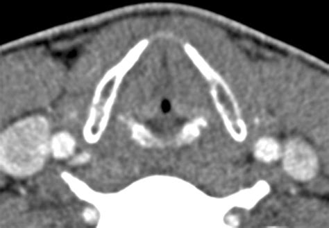 Unilateral Vocal Cord Paralysis A Review Of CT Findings Mediastinal
