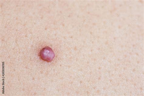 Skin Tag Is A Polyp Protruding From The Skin Stock Photo Adobe Stock
