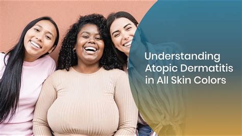 Understanding Atopic Dermatitis In Skin Of Color Youtube