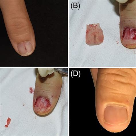 Modified Clex With Avulsion Of The Nail Plate And Postoperative