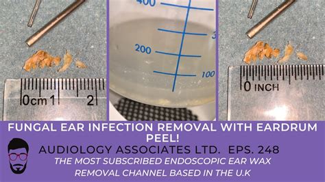Fungal Ear Infection Removal With Eardrum Peel Ep 248 Youtube